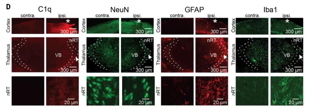 顱腦創傷后的繼發性腦損傷是怎么發生的？Science：補體介導炎癥及神經損傷！